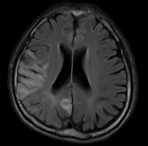 図３. 脳卒中様発作のMRI画像